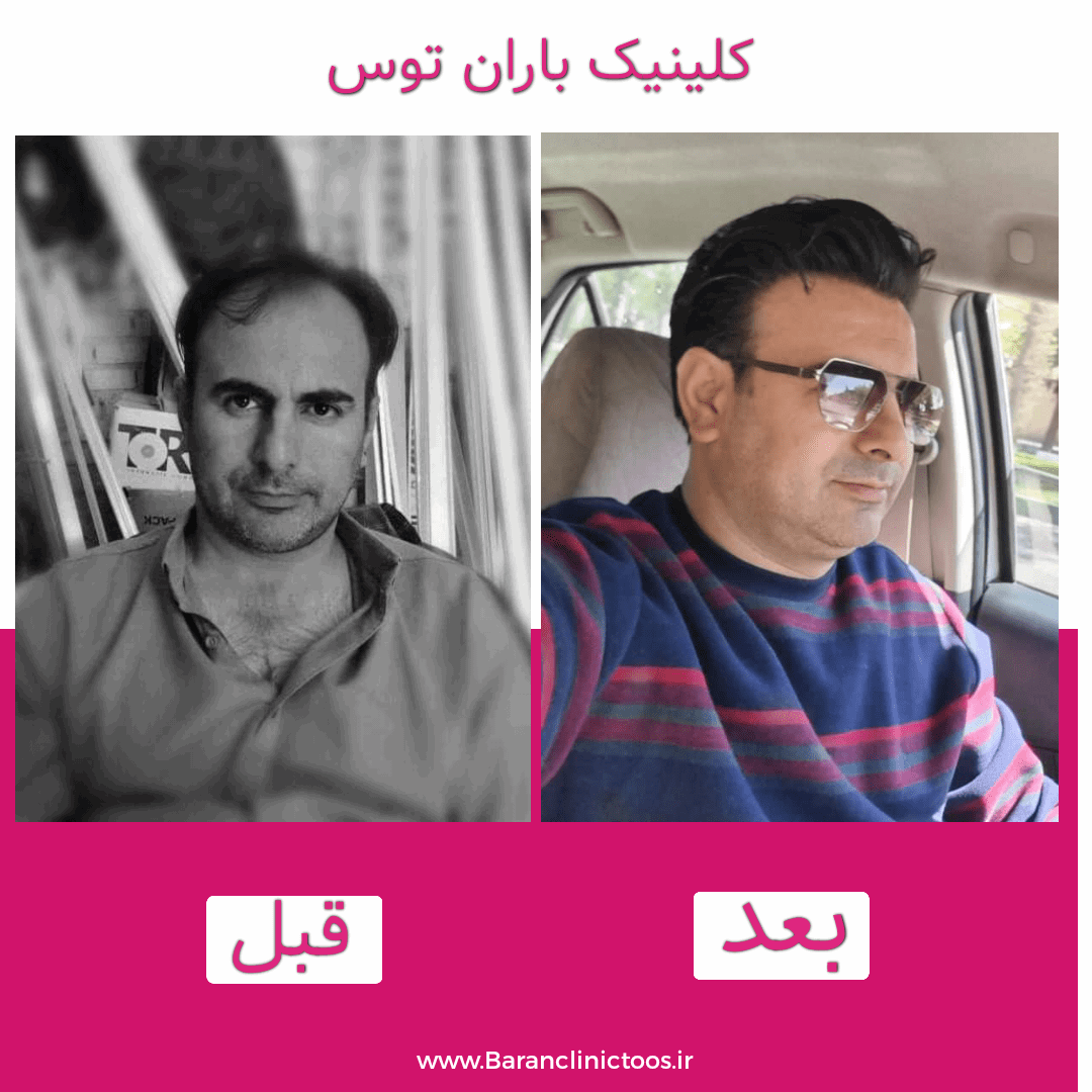 قبل و بعد کاشت مو